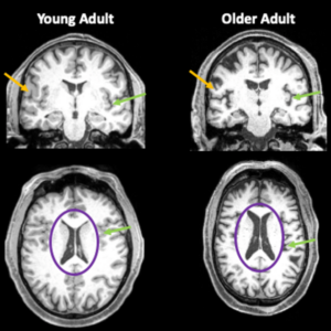 Brain images from a 35-year-old and an 85-year-old.